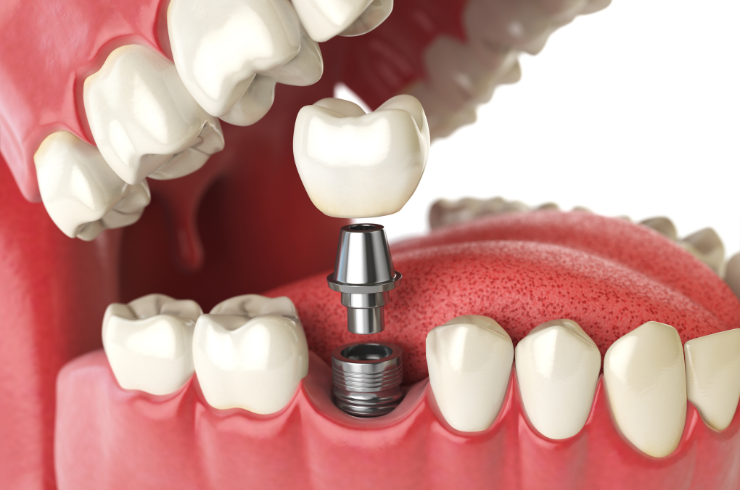 Dental Implants