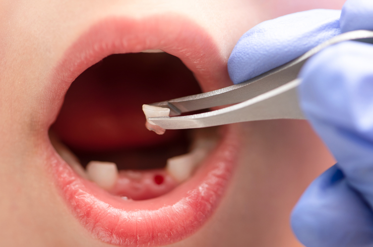 Tooth Extraction