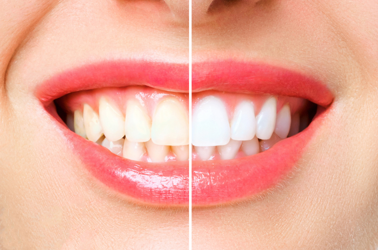 Tooth Whitening